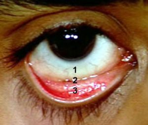 Figuur 6. De conjuctiva of het bindvlies bestaat uit drie in elkaar overlopende onderdelen. 1. de bulbaire conjunctiva die vast zit op de plaats waar de sclera overgaat in de cornea (de limbus). 2. de omslagplooi (de fornix). 3. de tarsale conjunctiva die de binnenzijde van de oogleden bekleedt.