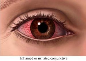Figuur 7. De conjunctiva is vrijwel doorzichtig. Onder bepaalde omstandigheden kunnen de bloedvaten van de conjunctiva echter uitzetten: bij een allergie, een ontsteking (conjunctivitis) of het te lang dragen van contactlenzen.